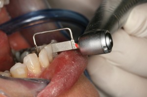 In the next step the operator use again Ortho-Strips OS40 to refine the treated area before polishing..