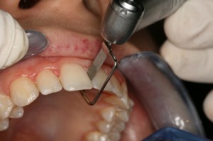 Final stage with polishing of treated areas with  Ortho-Strips OS15, 15µm, to avoid the following  deposit of bacterial placque.